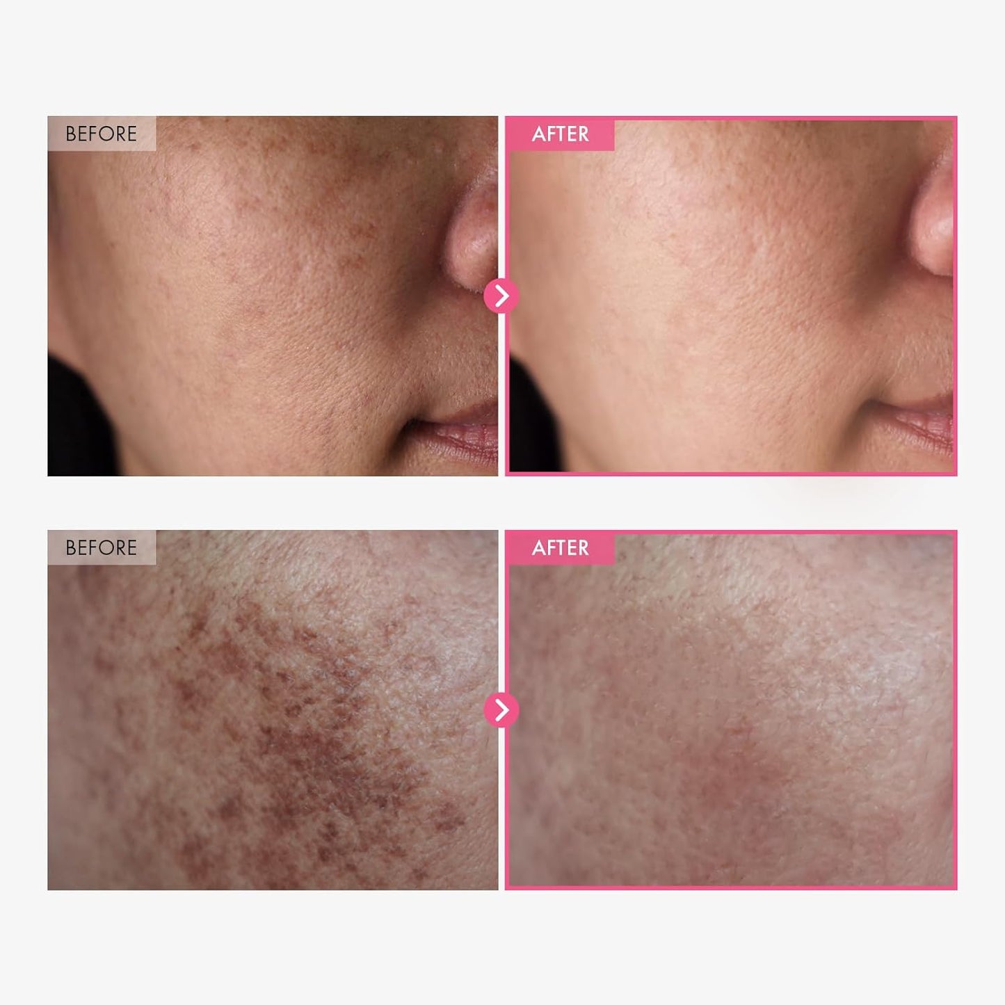 Carvency Arbutin + Tranexamic Acid Cream